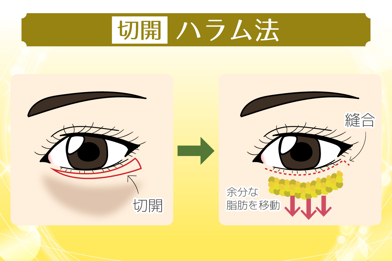 【切開】ハラム法